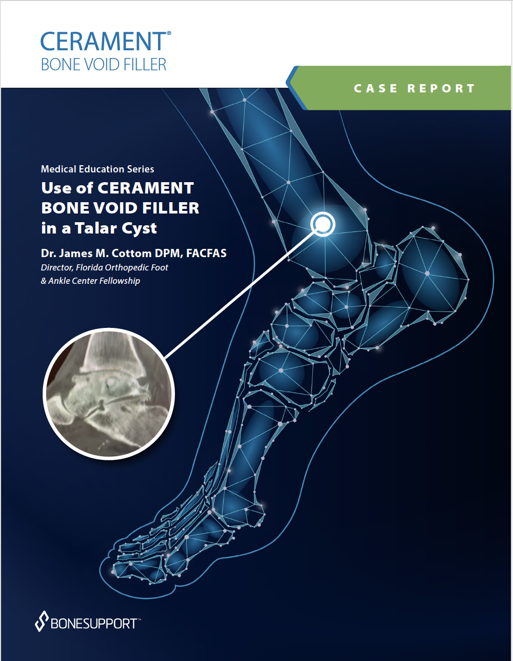 Use of CERAMENT® BONE VOID FILLER in a Talar Cyst